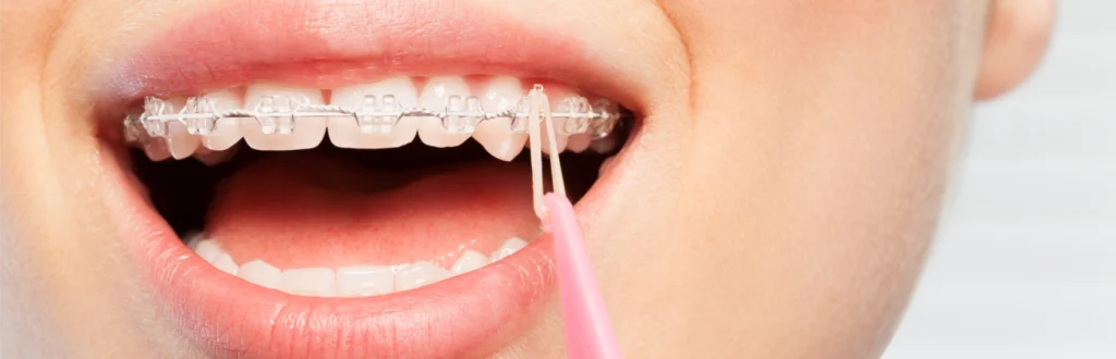 Port des élastiques Cabinet dentaire du Dr Matthieu Soto à Miramas