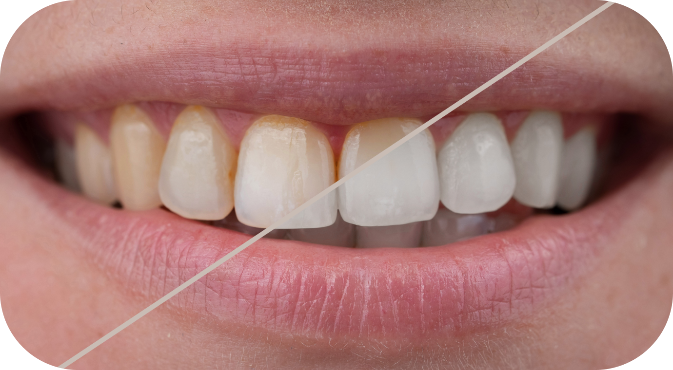 Éclaircissement dentaire Cabinet d’orthodontie du Dr Matthieu Soto à Miramas